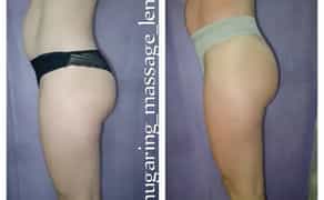 Антицелюлітний масаж – красива фігура швидко