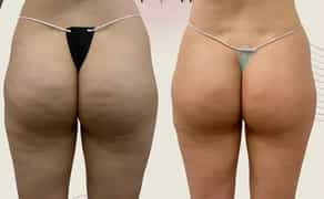 Класичний масаж, Антицелюлітний- моделюючий масаж