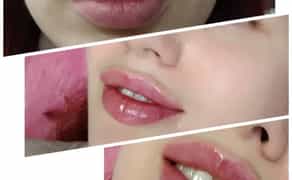 Збільшення губ спеціальна пропозиція. Процедура ботоксу.