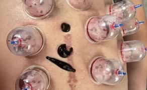 Хіджама. Гірудотерапія. Профілактика всіх захворювань. Навчання.