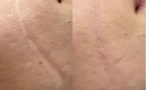 Мікроліндінг-Видалення шрамів-Рубці-Розтяжки 500 грн.