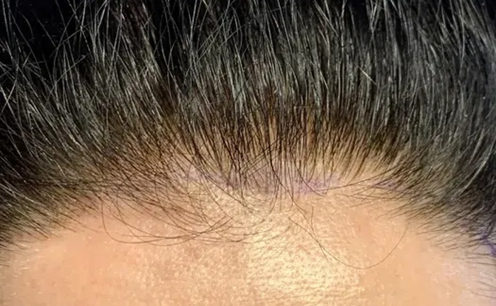 Електроепіляція у Харкові Електроепіляція у Харкові