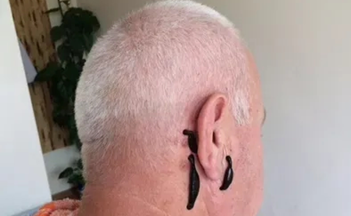 Лікування п‘явками( Гирудотерапія) Лікування п‘явками( Гирудотерапія)