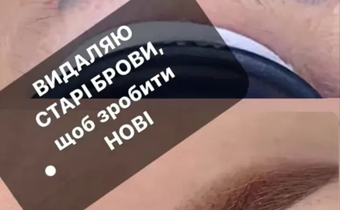 Лазерне видалення татуажу: брови, стрілки та губи. Лазерне видалення татуажу: брови, стрілки та губи.