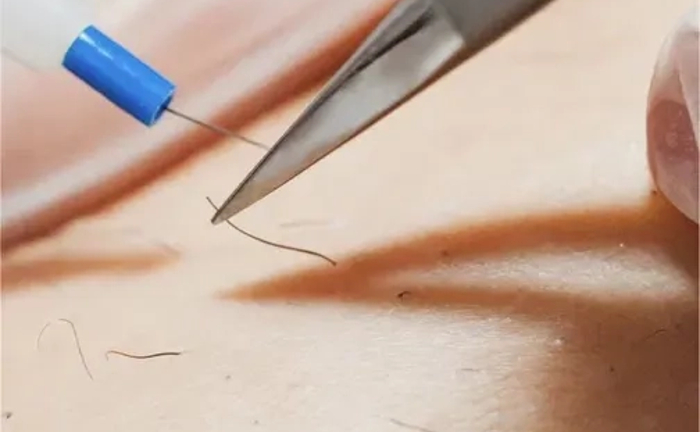 Електроепіляція - Єдиний метод видалення волосся НАЗАВЖДИ