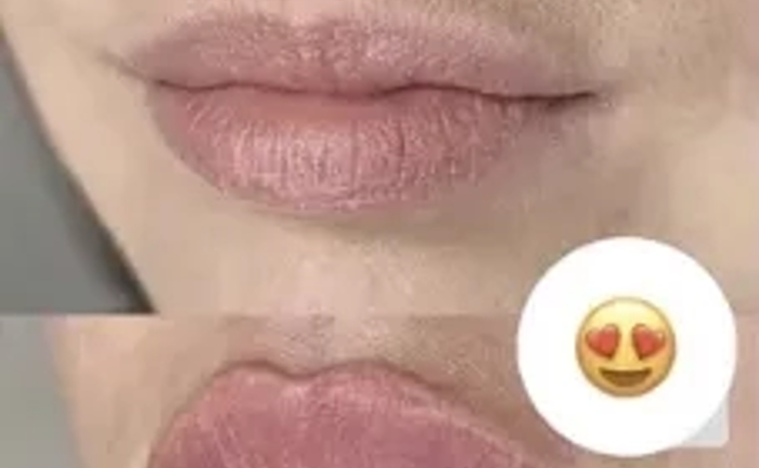 Збільшення губ троєщина 2000