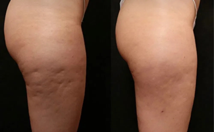 Антицелюлітний апаратний та ручний масаж м осокорки 600грн