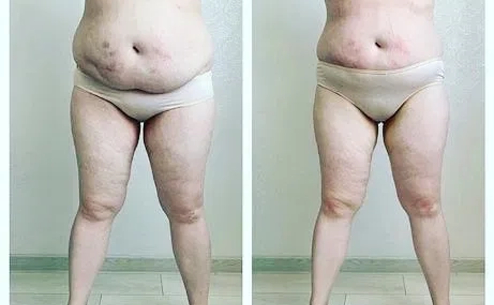 Ендосфера Терапія: Сеанс 60 Хвилин Всього за 400 грн! Ефективна Корекція Фігури!