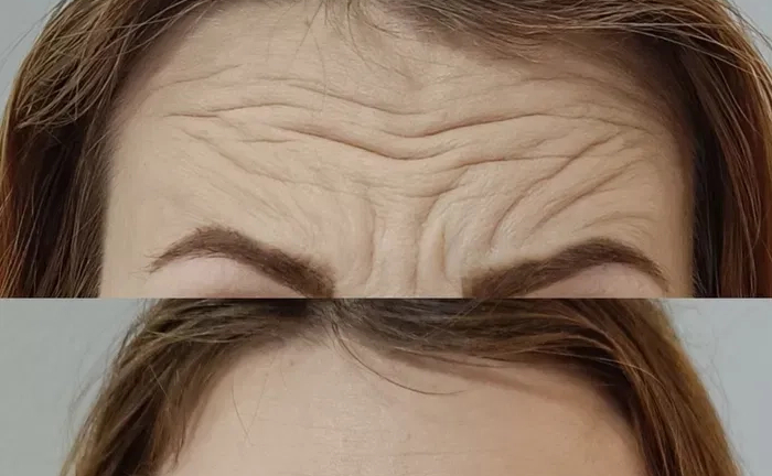 Запрошую на процедуру ботулінотерапії (ботокс). За допомогою цієї процедури можна позбутися мімічних зморшок. Запрошую на процедуру ботулінотерапії (ботокс). За допомогою цієї процедури можна позбутися мімічних зморшок.