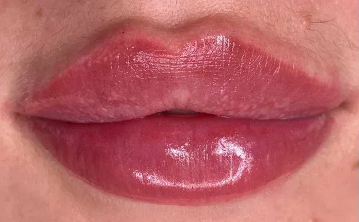 Збільшення губ без болю, без синців! Якісно! Філером гіалуронової кислоти. Збільшення губ без болю, без синців! Якісно! Філером гіалуронової кислоти.