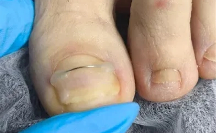 Подолог: Видалення мозолів, натоптишів та корекція врослого нігтя