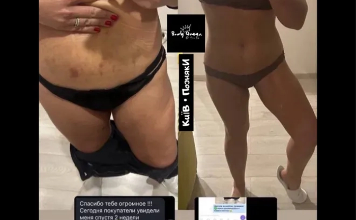 Антицелюлітний вакуумно - роликовий масаж. Дарницький район. Позняки.