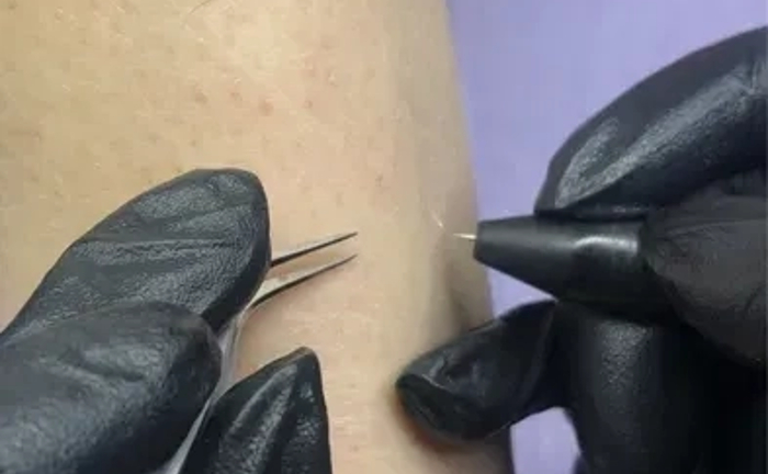 Навчання електроепіляції