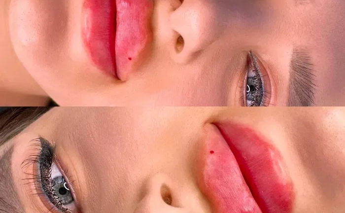 Косметолог. Акція. Збільшення губ за ціною препарату