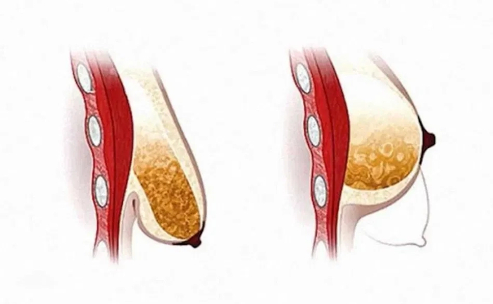 Моделюючий масаж жіночих грудей. Масаж при забоях, ущільненнях. Моделюючий масаж жіночих грудей. Масаж при забоях, ущільненнях.