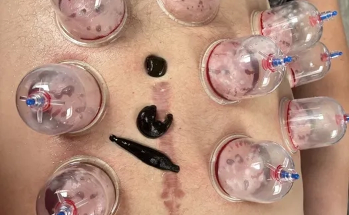 Хіджама. Гірудотерапія. Профілактика всіх захворювань. Навчання.