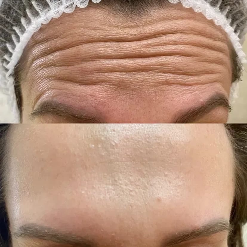 Косметолог (ботокс, контурная пластика губ,мезо, біоревіталізація)