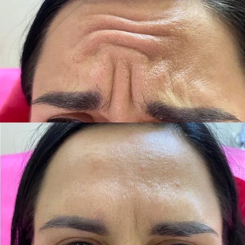 Косметолог (ботокс, контурная пластика губ,мезо, біоревіталізація)