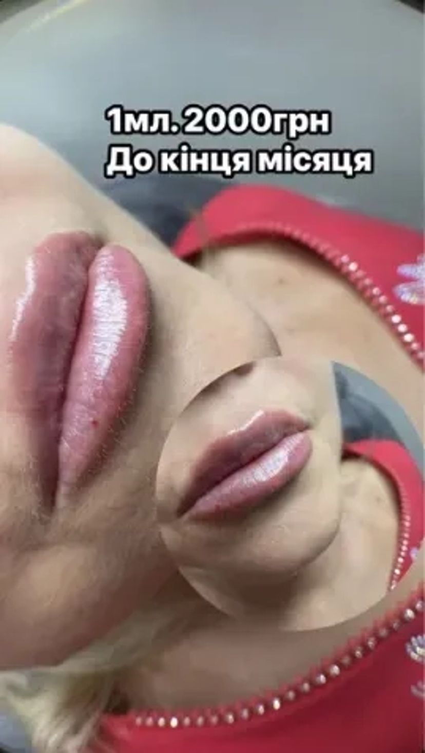 Збільшення губ троєщина 2000