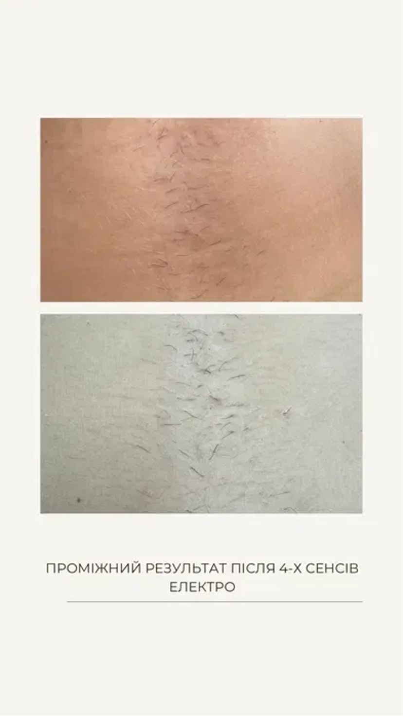 Лазерна епіляція, електроепіляція, электро, депиляция, депіляція