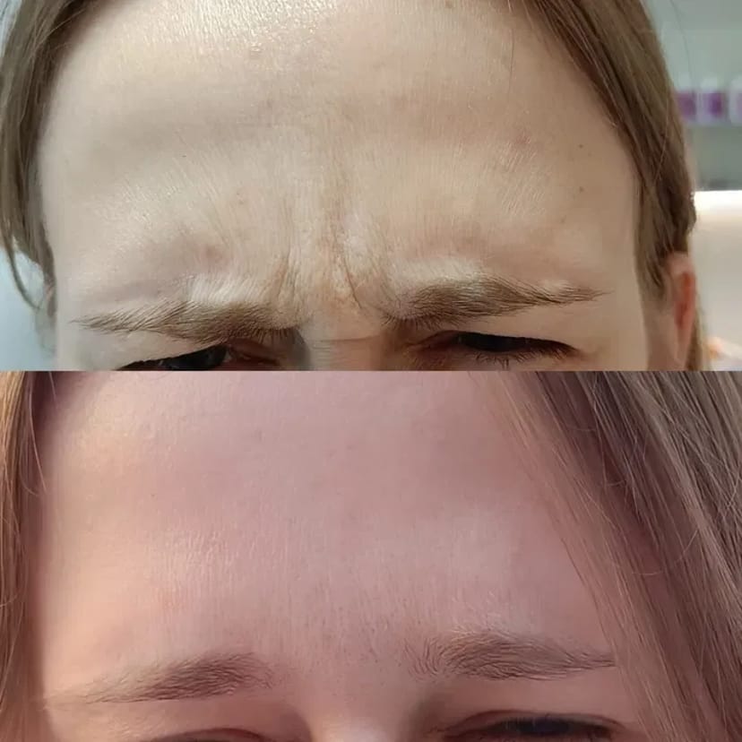 Запрошую на процедуру ботулінотерапії (ботокс). За допомогою цієї процедури можна позбутися мімічних зморшок.