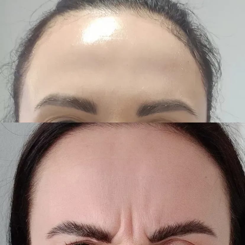 Запрошую на процедуру ботулінотерапії (ботокс). За допомогою цієї процедури можна позбутися мімічних зморшок.