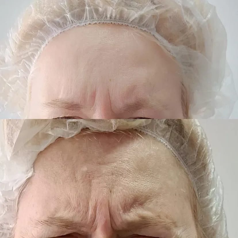 Запрошую на процедуру ботулінотерапії (ботокс). За допомогою цієї процедури можна позбутися мімічних зморшок.