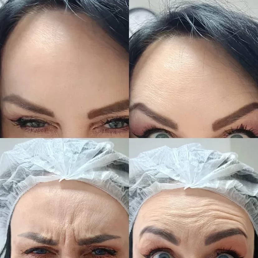 Запрошую на процедуру ботулінотерапії (ботокс). За допомогою цієї процедури можна позбутися мімічних зморшок.