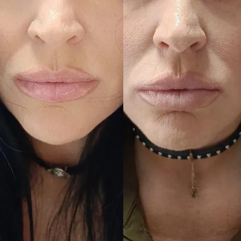 Запрошую на процедуру ботулінотерапії (ботокс). За допомогою цієї процедури можна позбутися мімічних зморшок.