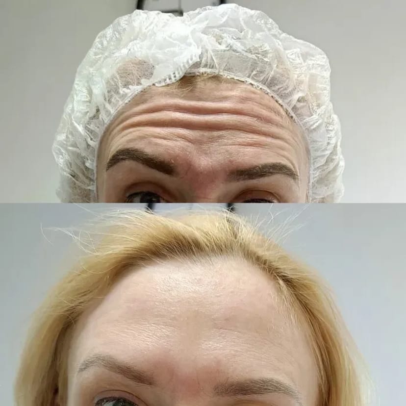 Запрошую на процедуру ботулінотерапії (ботокс). За допомогою цієї процедури можна позбутися мімічних зморшок.