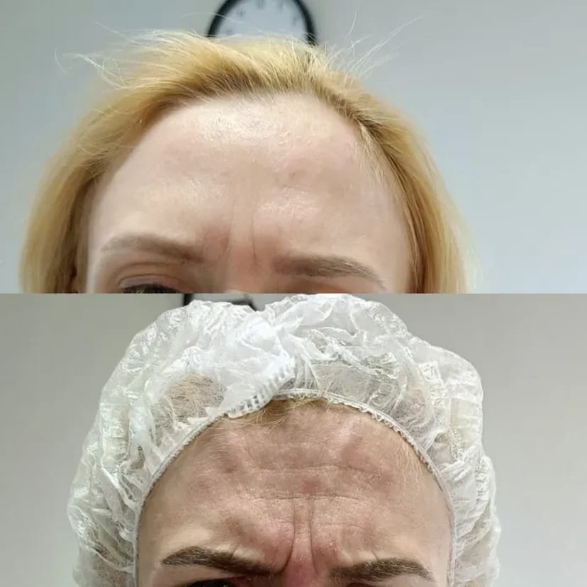 Запрошую на процедуру ботулінотерапії (ботокс). За допомогою цієї процедури можна позбутися мімічних зморшок.