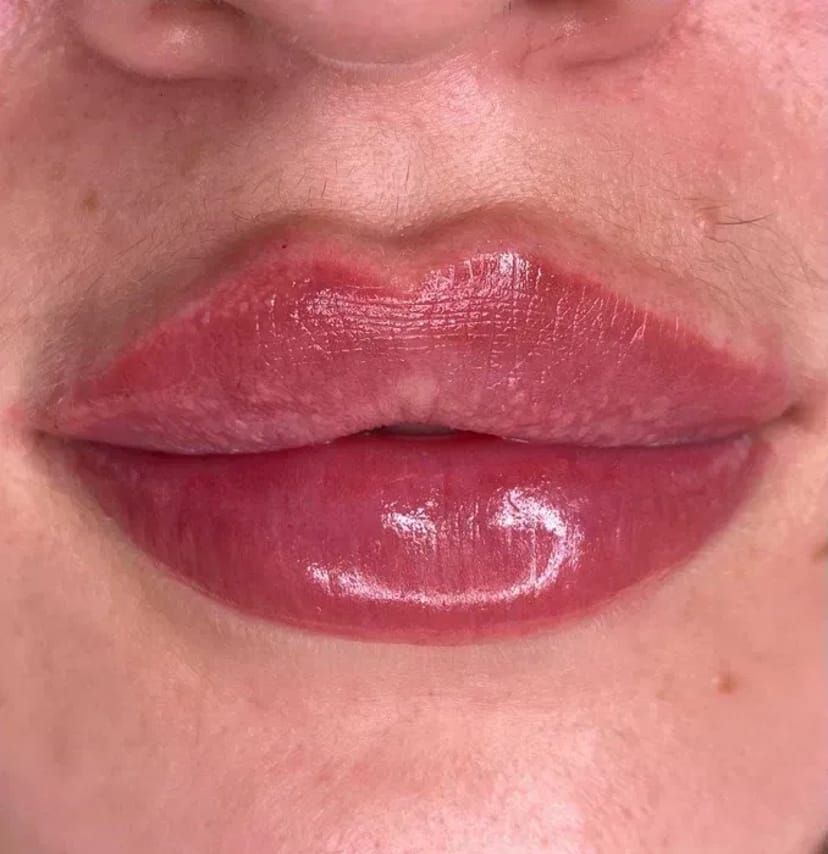 Збільшення губ без болю, без синців! Якісно! Філером гіалуронової кислоти.