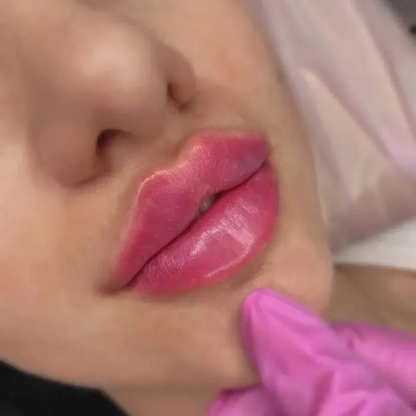 Збільшення губ без болю, без синців! Якісно! Філером гіалуронової кислоти.