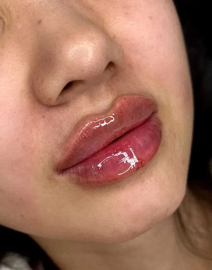 Збільшення губ без болю, без синців! Якісно! Філером гіалуронової кислоти.