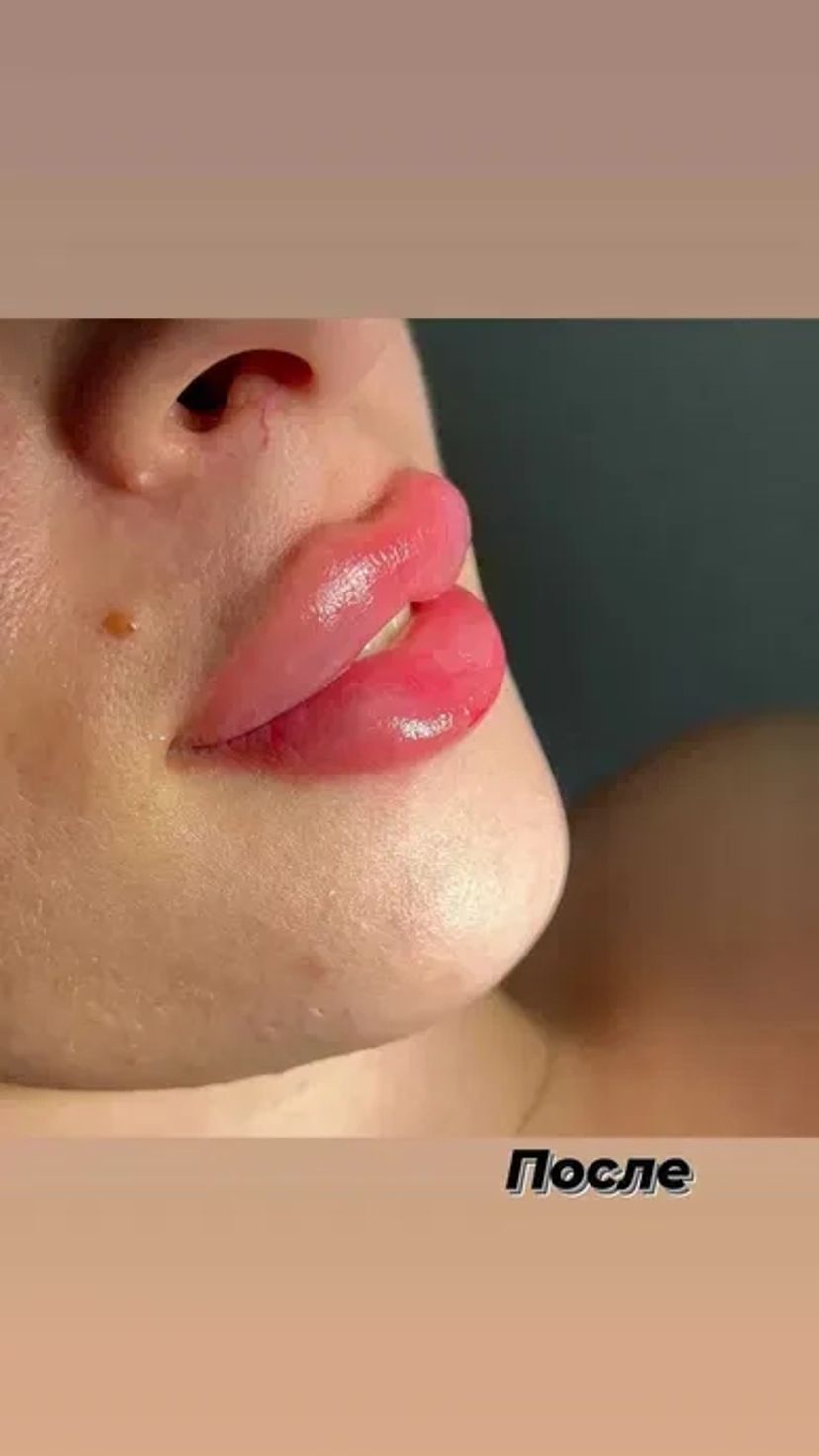 Збільшення губ без болю, без синців! Якісно! Філером гіалуронової кислоти.