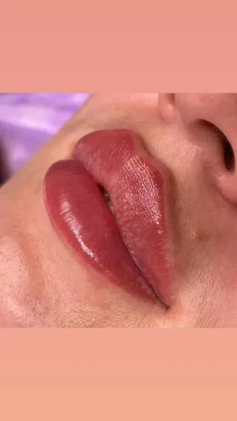 Збільшення губ без болю, без синців! Якісно! Філером гіалуронової кислоти.