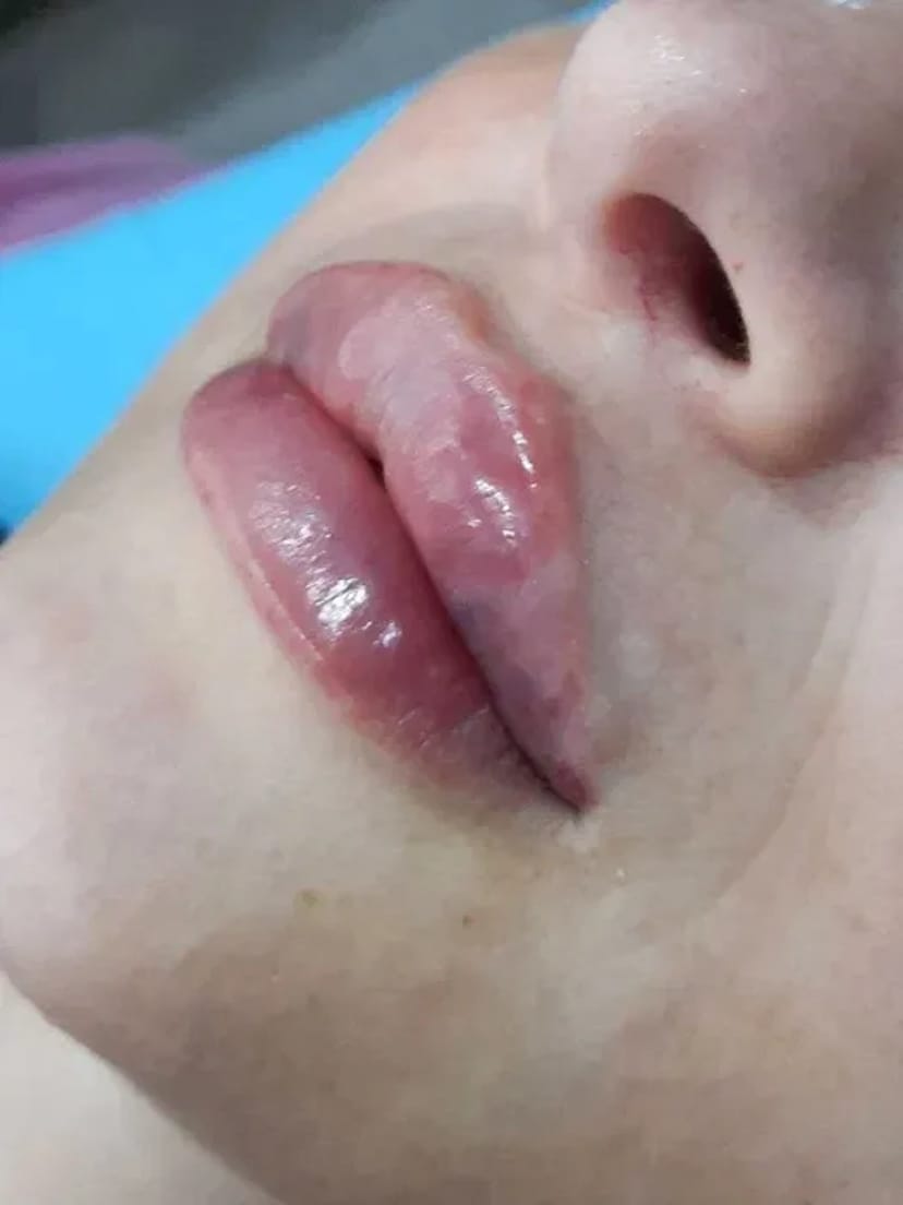 Збільшення губ без болю, без синців! Якісно! Філером гіалуронової кислоти.