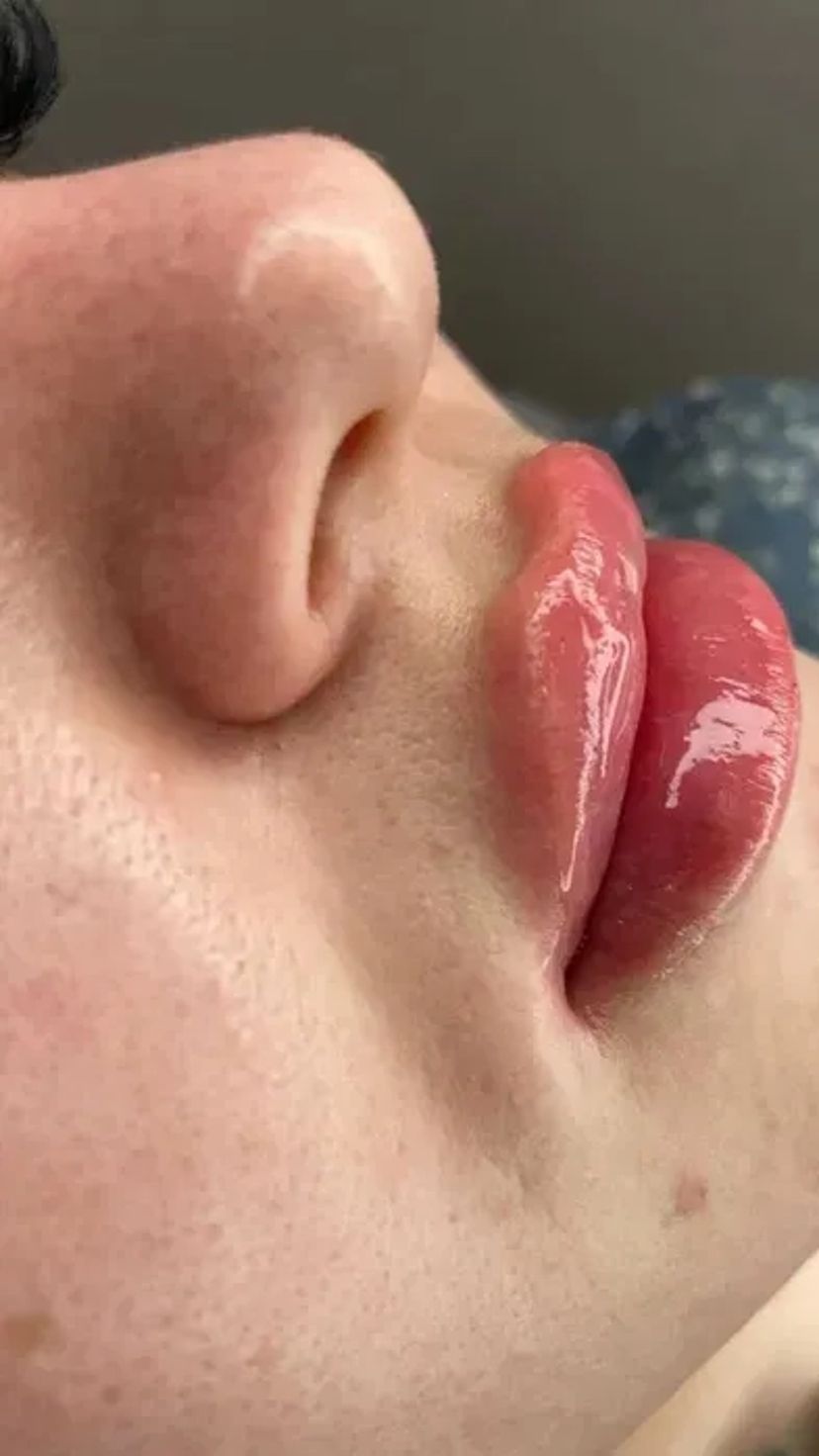 Збільшення губ без болю, без синців! Якісно! Філером гіалуронової кислоти.