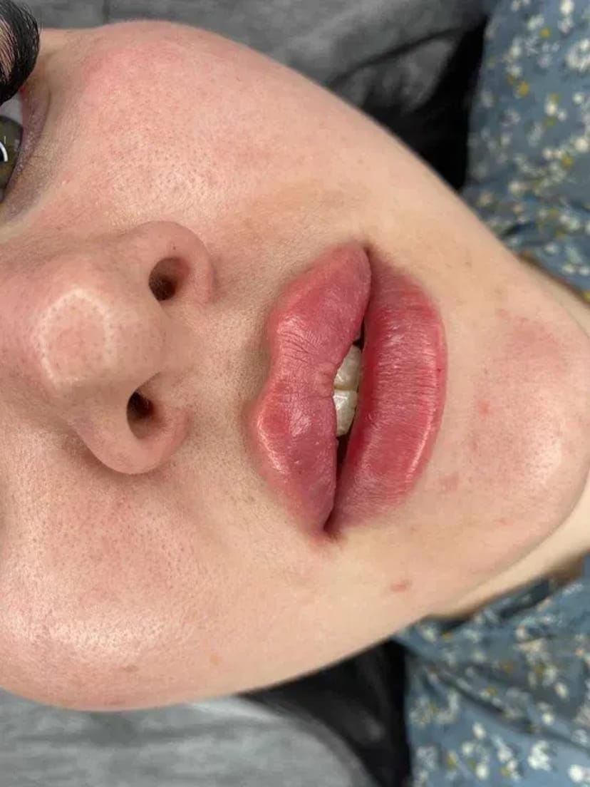 Збільшення губ без болю, без синців! Якісно! Філером гіалуронової кислоти.