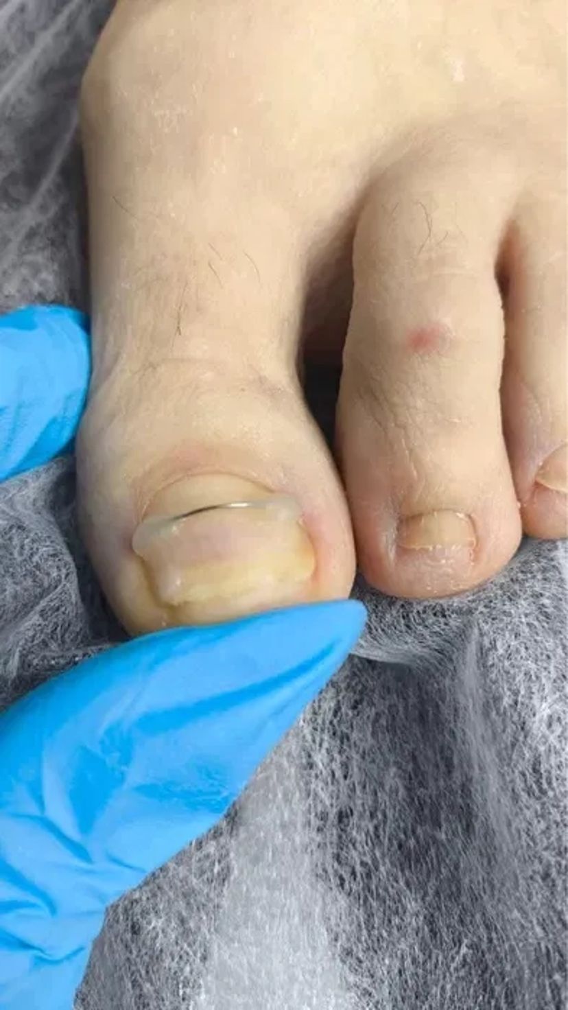 Подолог: Видалення мозолів, натоптишів та корекція врослого нігтя