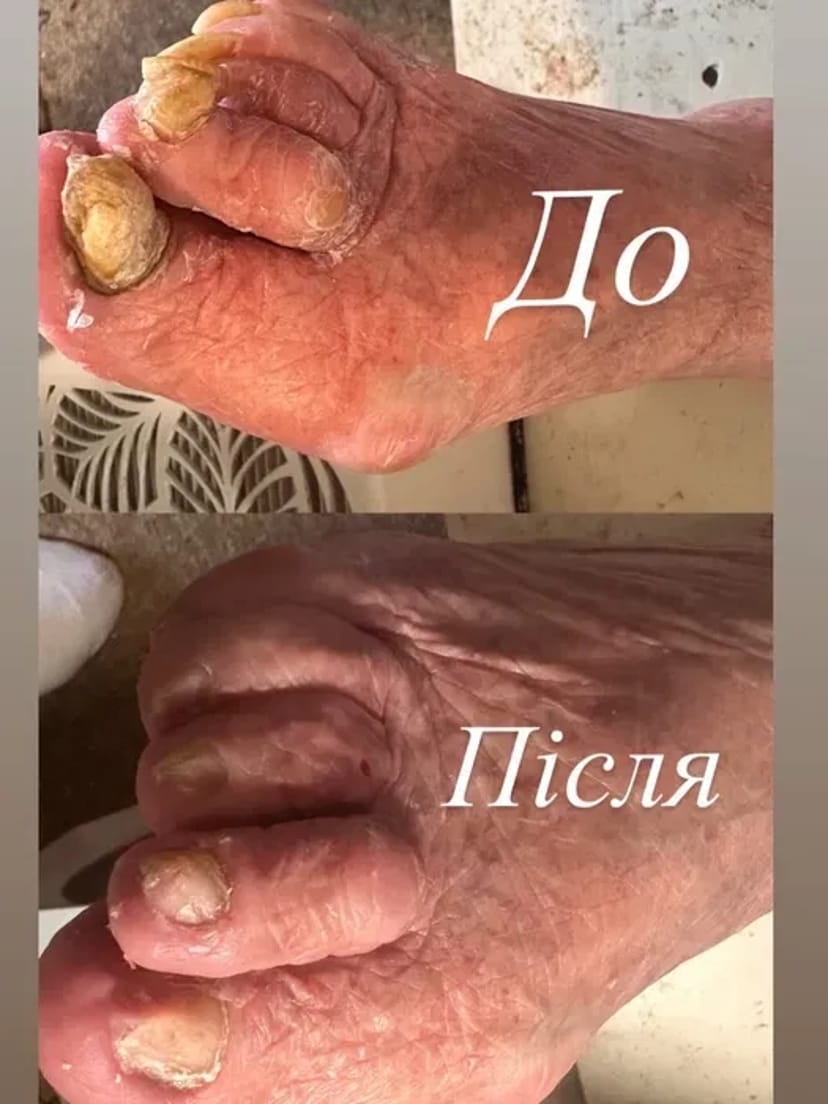 Подолог: Видалення мозолів, натоптишів та корекція врослого нігтя