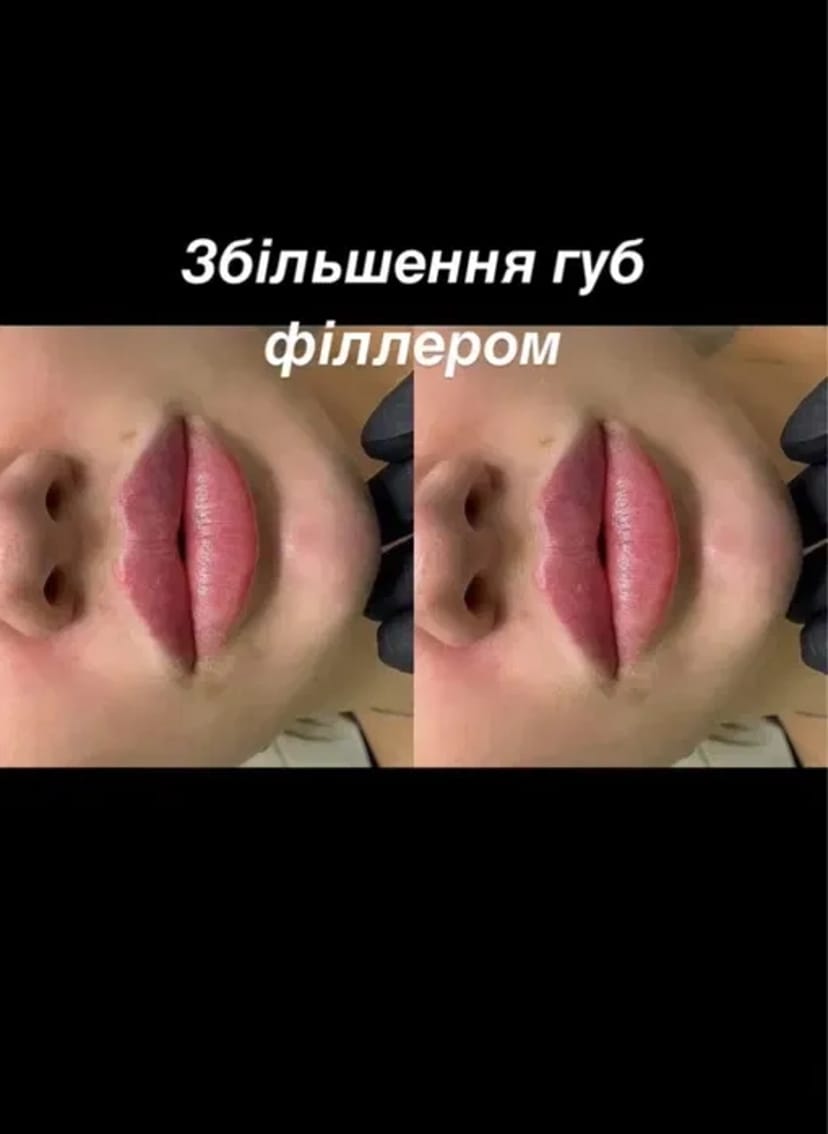 Косметологія, корекція збільшення Губ, Ботокс, Апаратний ліфтинг!