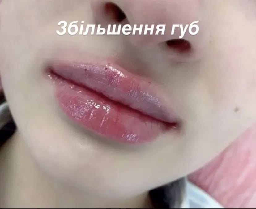 Косметологія, корекція збільшення Губ, Ботокс, Апаратний ліфтинг!