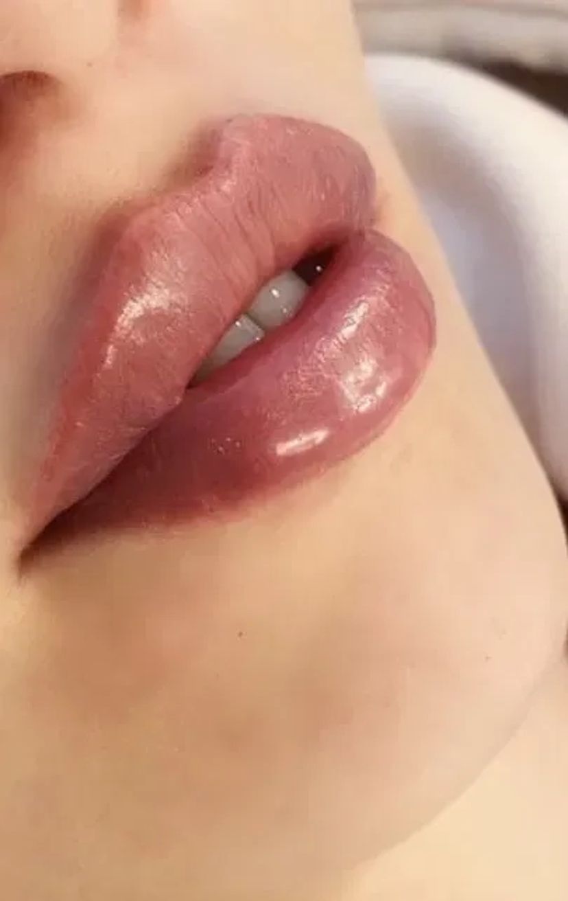 Косметологія, корекція збільшення Губ, Ботокс, Апаратний ліфтинг!