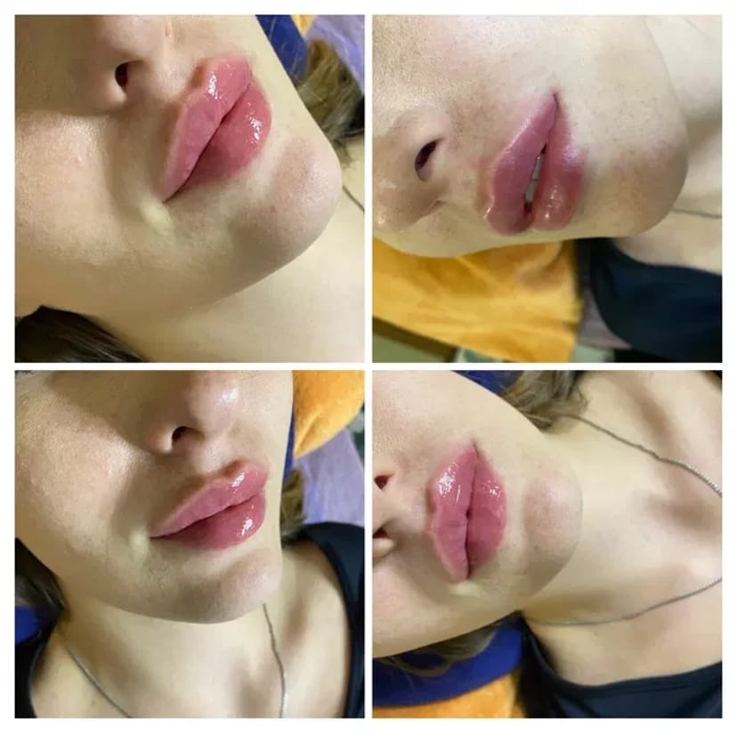 Косметологія, корекція збільшення Губ, Ботокс, Апаратний ліфтинг!