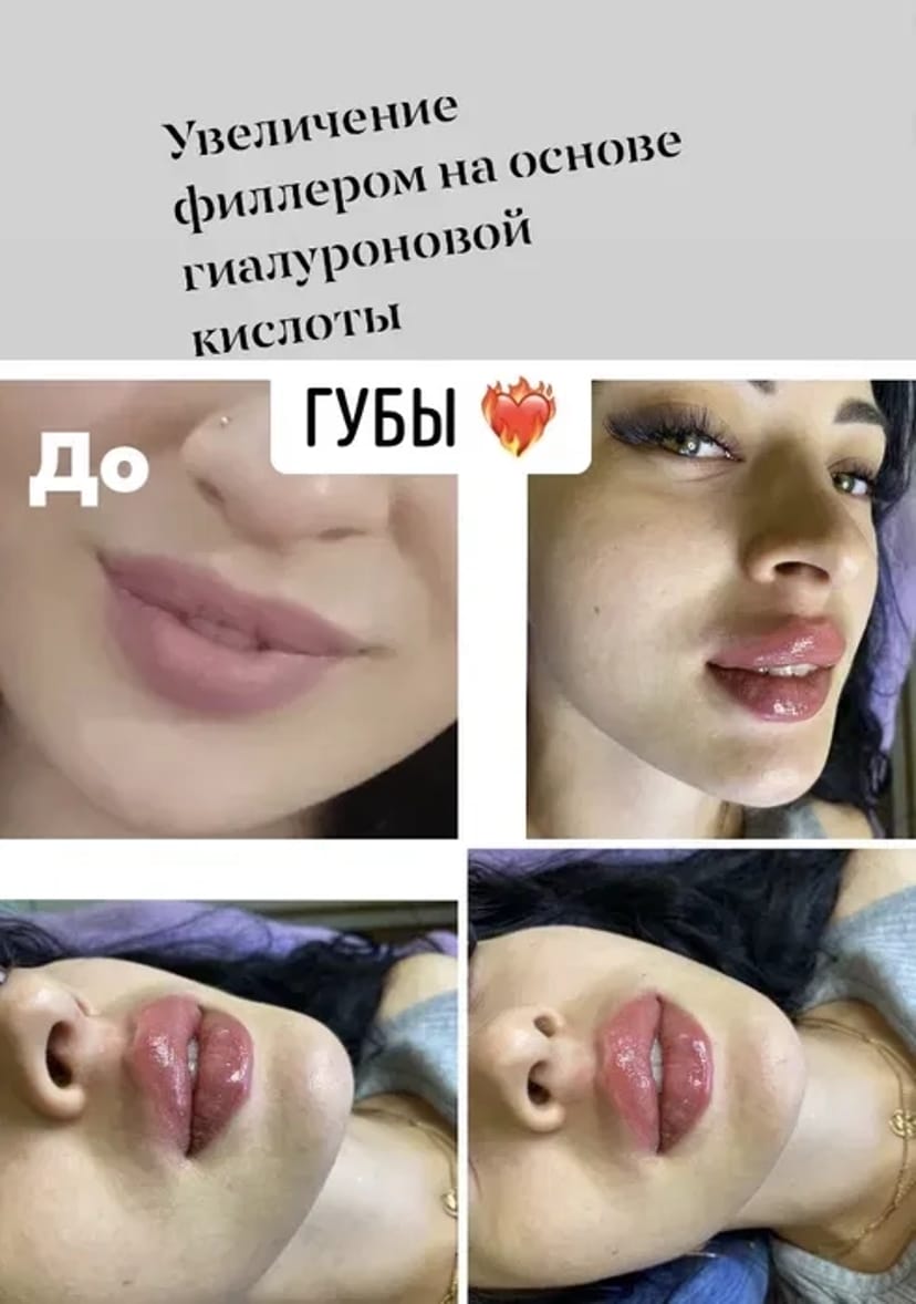 Косметологія, корекція збільшення Губ, Ботокс, Апаратний ліфтинг!