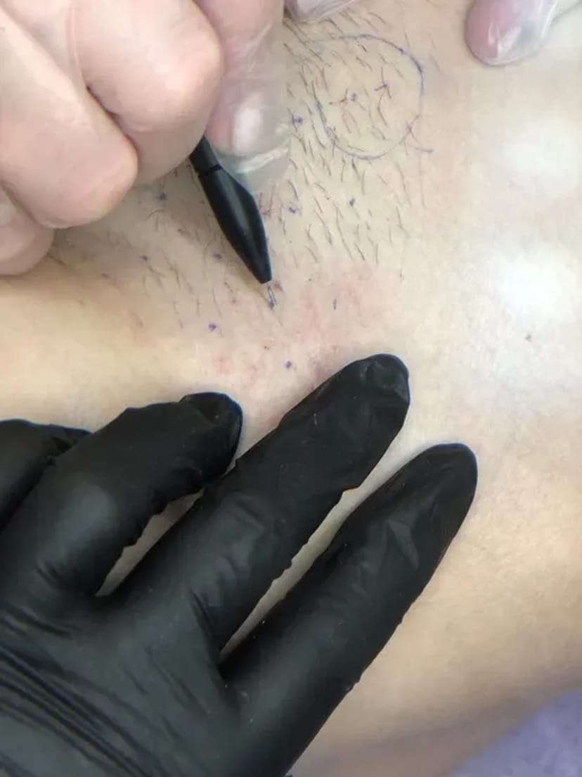 Навчання електроепіляції