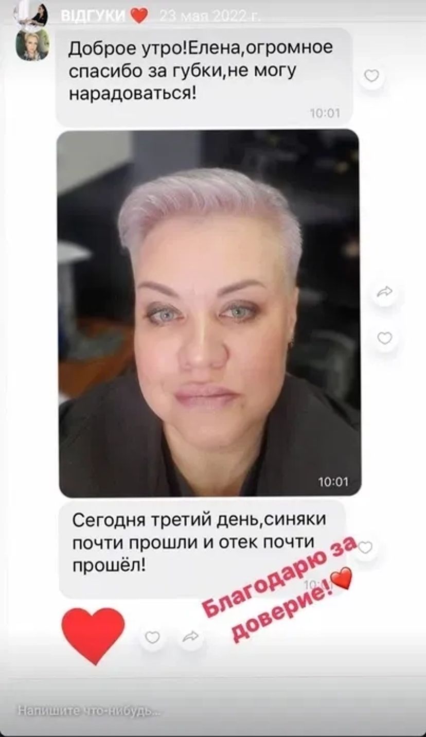 Ботокс, біоревіталізація. Супер АКЦІЯ 850 грн!