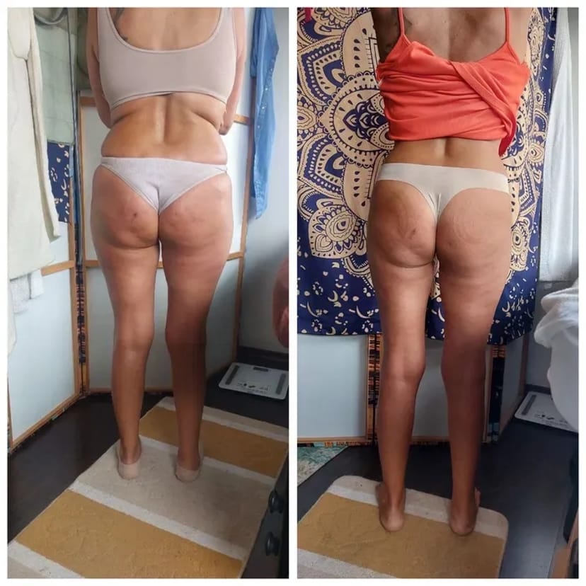 Антицеллюлитный массаж и шугаринг: идеальное тело и гладкая кожа.