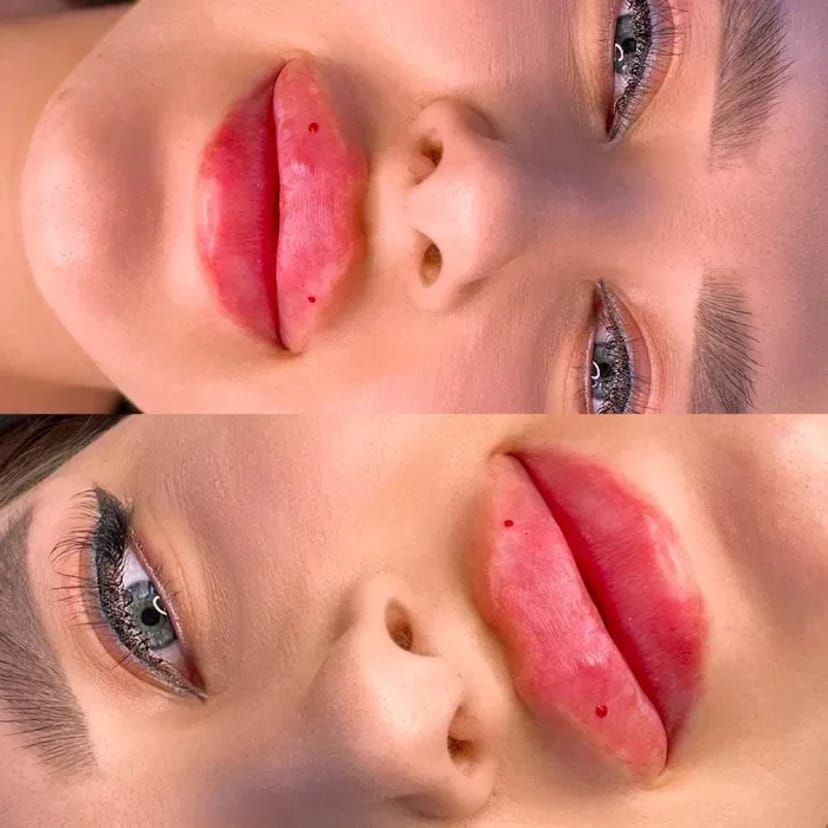 Косметолог. Акція. Збільшення губ за ціною препарату